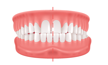 Crossbite Crossbite